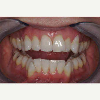 35-44 year old woman treated with Invisalign before 3735977