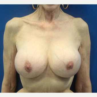 65-74 year old woman treated with Breast Implant Revision after 3366537