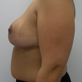 25-34 year old woman treated with Breast Reduction 3814522