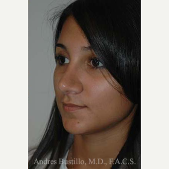 20 year old woman treated with Rhinoplasty after 3462342