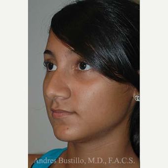 20 year old woman treated with Rhinoplasty before 3462342