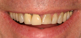 55 Year Old Male gets Smile Makeover before 859010