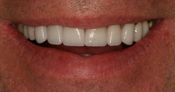 55 Year Old Male gets Smile Makeover after 859010