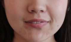 Fillers to Nasolabial Folds/Midface before 626023