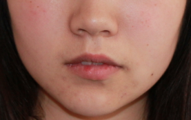 Fillers to Nasolabial Folds/Midface after 626023
