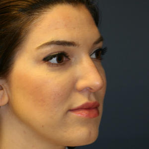 25-34 year old woman treated with Rhinoplasty before 3559822