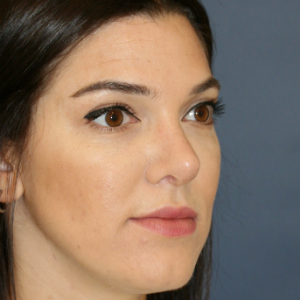 25-34 year old woman treated with Rhinoplasty after 3559822
