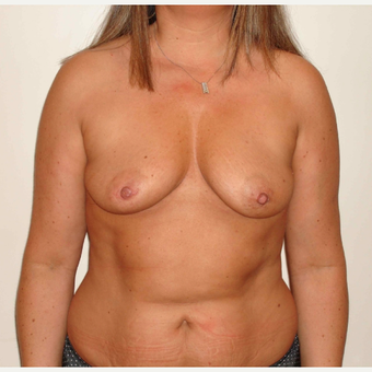 45-54 year old woman treated with Breast Augmentation before 3664802