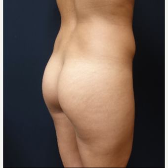 25-34 year old woman treated with 548cc Round Silicone Butt Implants for her Augmentation before 3043077