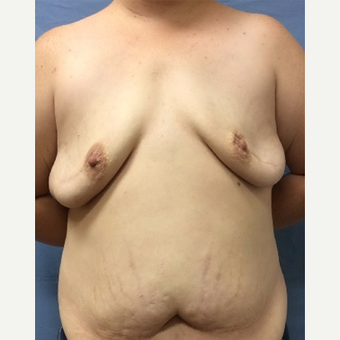 35-44 year old woman treated with Breast Reconstruction before 3630751