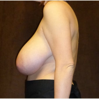 25-34 year old woman treated with Breast Reduction 1833290