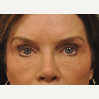 55-64 year old woman treated with Fat Transfer after 3042167