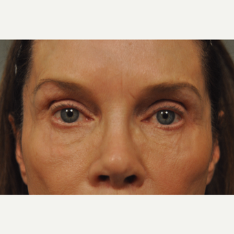 55-64 year old woman treated with Fat Transfer before 3042167