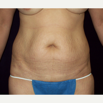45-54 year old woman with a Full Tummy Tuck before 3141723