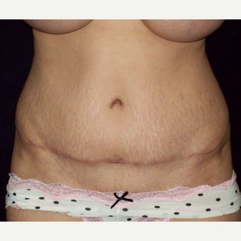 45-54 year old woman with a Full Tummy Tuck after 3141723