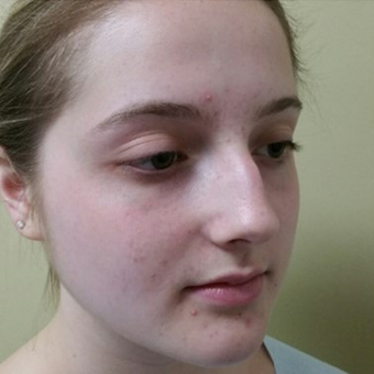 18-24 year old woman treated with Rhinoplasty before 3686257