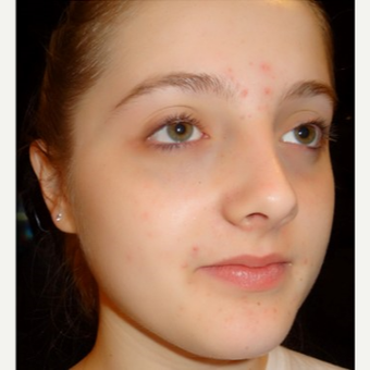 18-24 year old woman treated with Rhinoplasty after 3686257