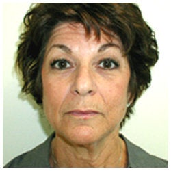 Upper and lower eyelids / face and neck lift and brow lift. 334397