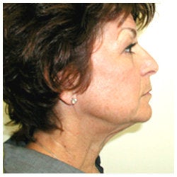 Upper and lower eyelids / face and neck lift and brow lift. before 334397