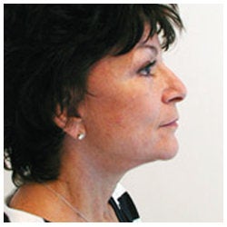 Upper and lower eyelids / face and neck lift and brow lift. after 334397