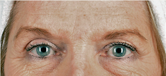 68 year old woman treated with Brow Lift before 3839949