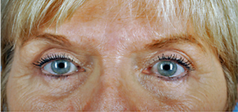 68 year old woman treated with Brow Lift after 3839949