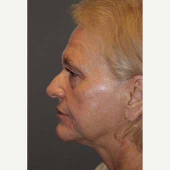 65-74 year old woman treated with Facelift before 3383810