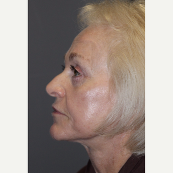 65-74 year old woman treated with Facelift after 3383810