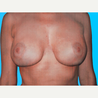 Breast Lift with Implants after 3748858