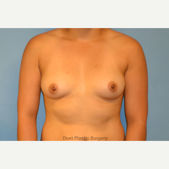 24 year old woman treated with saline breast implants before 3105923