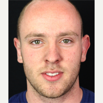 18-24 year old man treated with Ear Surgery before 3020603