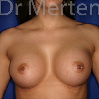 25-34 year old woman treated with Breast Augmentation after 3551926