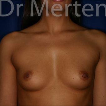 25-34 year old woman treated with Breast Augmentation before 3551926