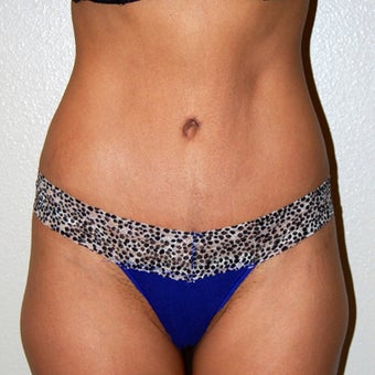 Tummy Tuck - Abdominoplasty after 1341250