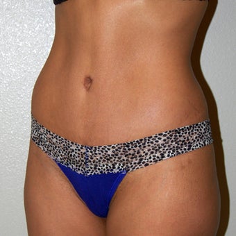 Tummy Tuck - Abdominoplasty 1341250