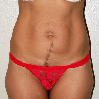 Tummy Tuck - Abdominoplasty before 1341250