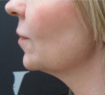 CoolSculpting: Before & After Results for Double Chin after 3297278