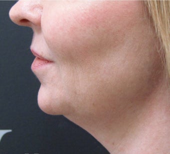 CoolSculpting: Before & After Results for Double Chin before 3297278