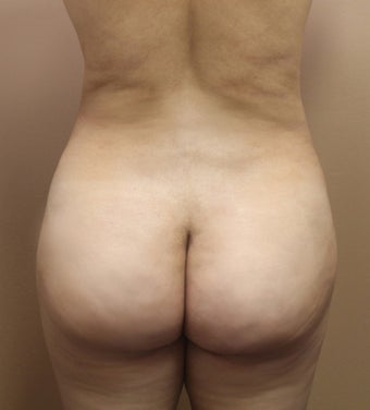 34 year old woman treated with Brazillian Butt Lift after 2062944