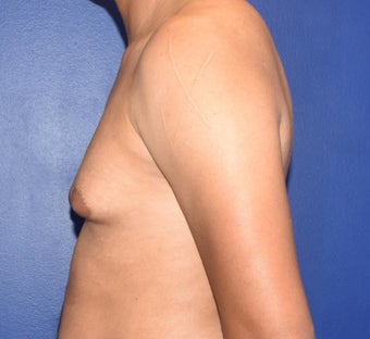 25-34 year old man treated with Laser Liposuction & Excision of Bilateral Breast Buds 3508787