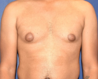 25-34 year old man treated with Laser Liposuction & Excision of Bilateral Breast Buds before 3508787