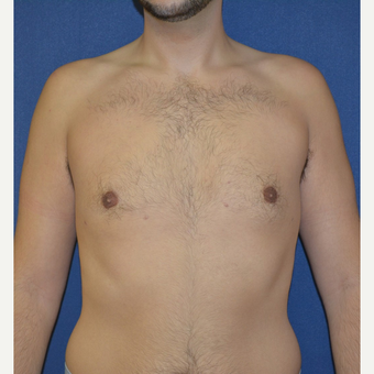 18-24 year old man treated with Male Breast Reduction after 3225516