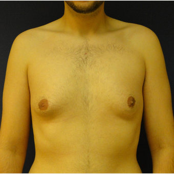 18-24 year old man treated with Male Breast Reduction before 3225516
