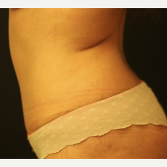 35-44 year old woman treated with Tummy Tuck after 3764610