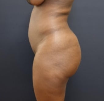 35-44 year old woman treated with Butt Augmentation before 3200917