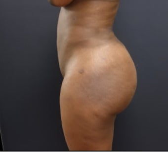35-44 year old woman treated with Butt Augmentation after 3200917
