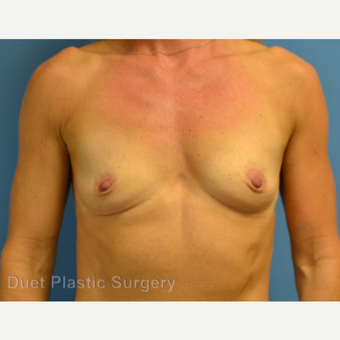 45-54 year old woman treated with Breast Augmentation before 3342134