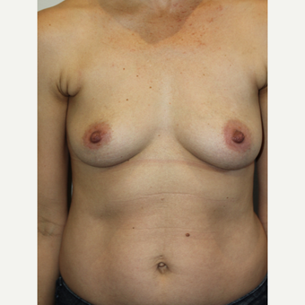 45-54 year old woman treated with Breast Augmentation before 3015291