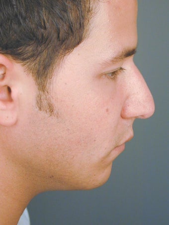 Male Chin Implant before 831471
