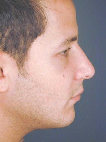 Male Chin Implant after 831471
